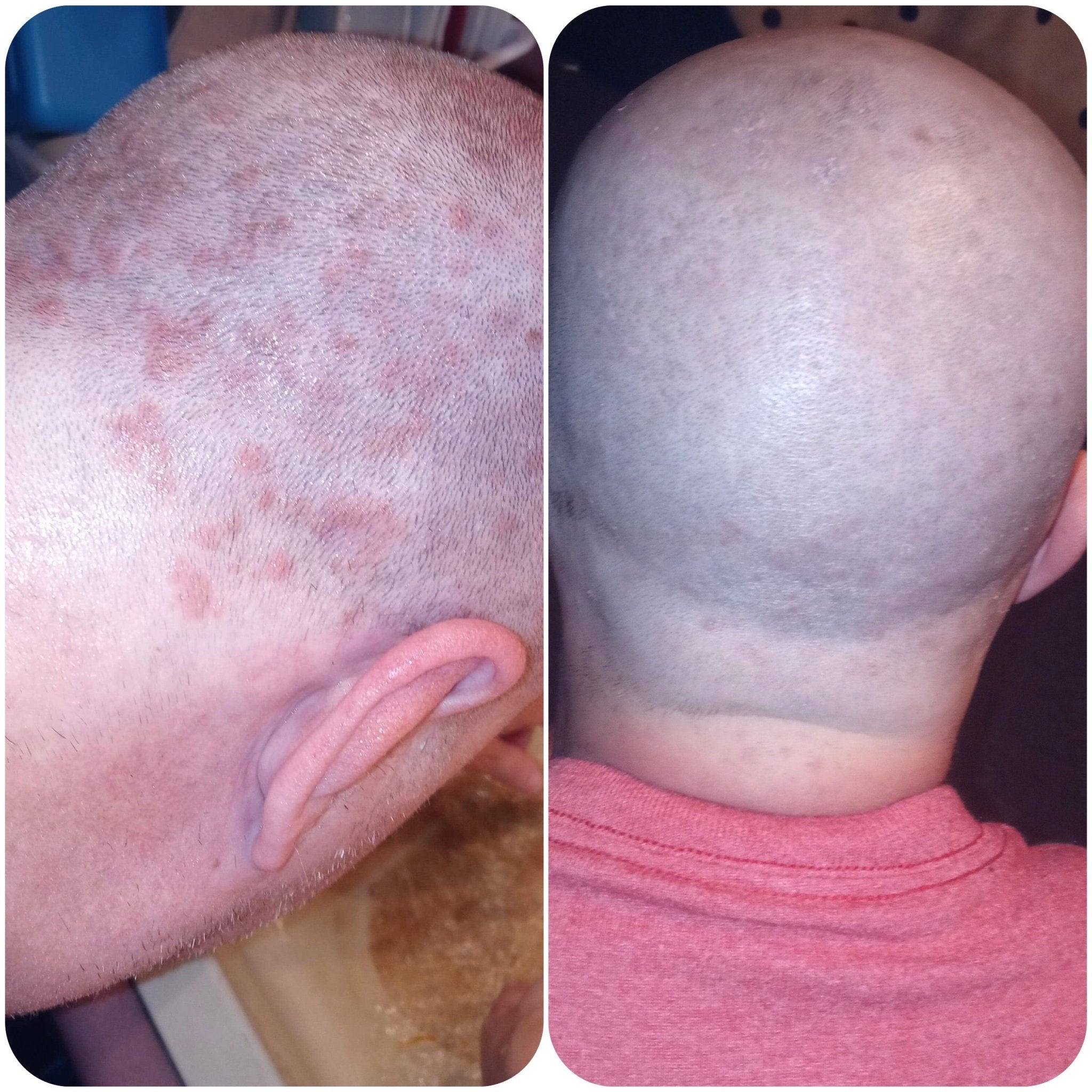 Side-by-side images of a shaved head showing improvement in a skin condition. The left image exhibits red, inflamed spots and itchy flakes, while the right image shows significantly reduced redness and clearer skin thanks to Bea&