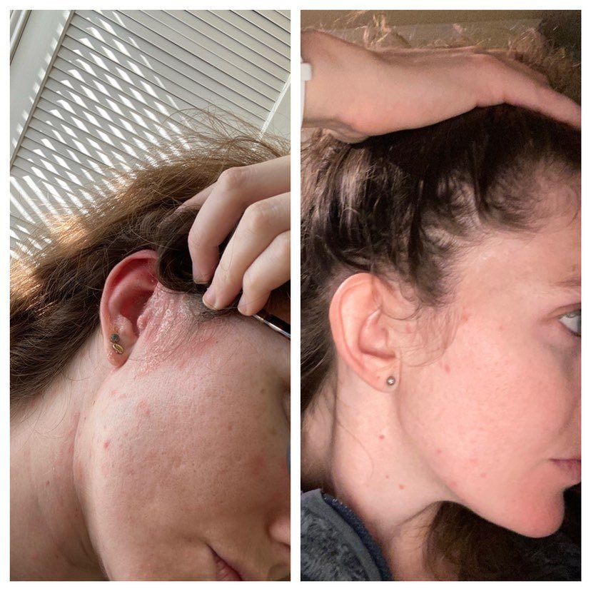 A side-by-side comparison shows the left profile of the same person. The left image displays red, irritated skin around the ear and cheek. The right image reveals significantly improved skin with reduced redness and irritation in the same area, thanks to Good Biome Prebiotic Facial Renew Solution from Bea&